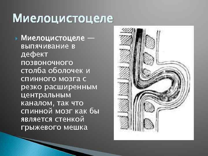 Миелоцистоцеле — выпячивание в дефект позвоночного столба оболочек и спинного мозга с резко расширенным