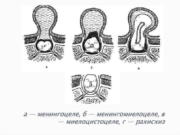 а — менингоцеле, б — менингомиелоцеле, в — миелоцистоцеле, г — рахисхиз 