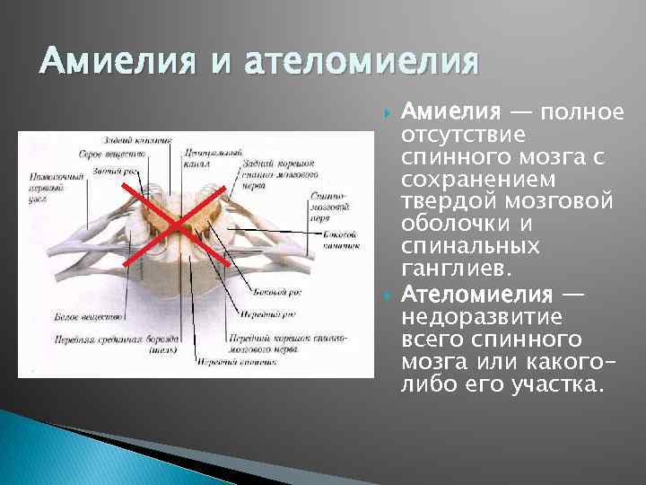 Амиелия и ателомиелия Амиелия — полное отсутствие спинного мозга с сохранением твердой мозговой оболочки