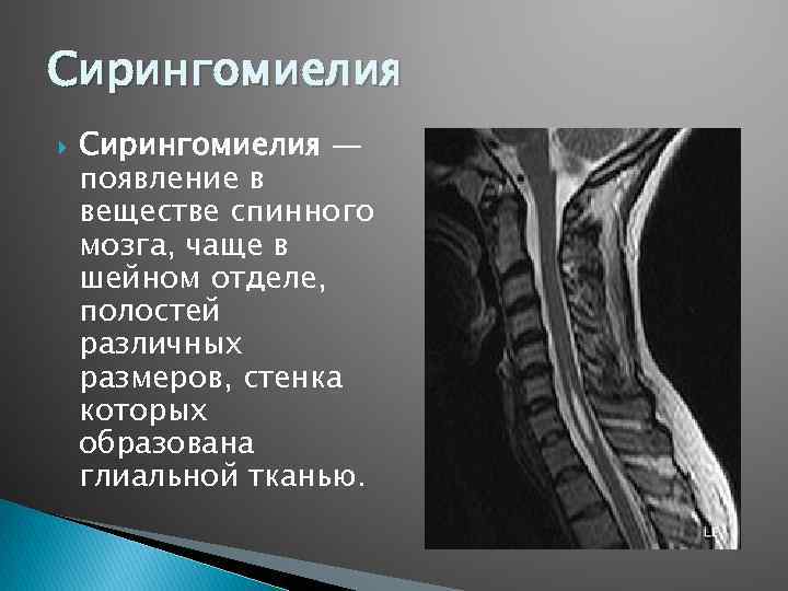 Сирингомиелия — появление в веществе спинного мозга, чаще в шейном отделе, полостей различных размеров,