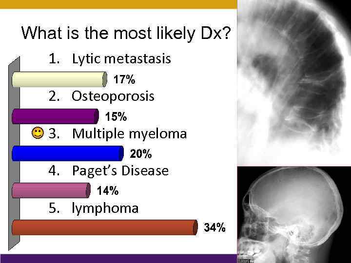 What is the most likely Dx? 1. Lytic metastasis 2. Osteoporosis 3. Multiple myeloma