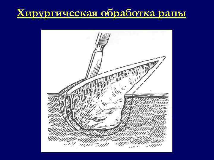 Первично отсроченная хирургическая обработка. Хирургическая обработка раны. Поздняя хирургическая обработка раны. Ранняя хирургическая обработка. Хирургическая обработка раны виды.