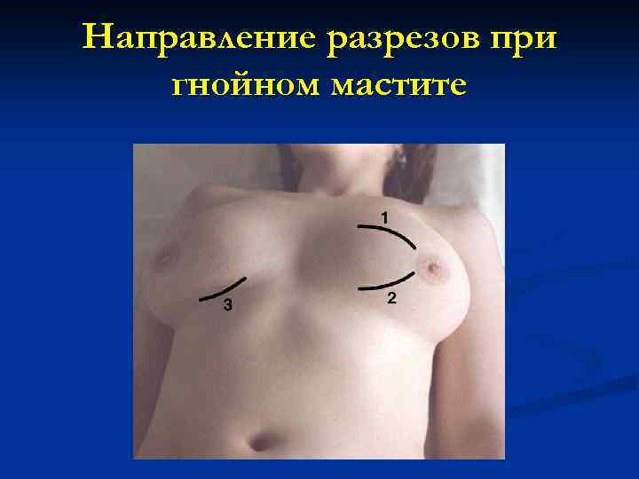 Направление разрезов при гнойном мастите 