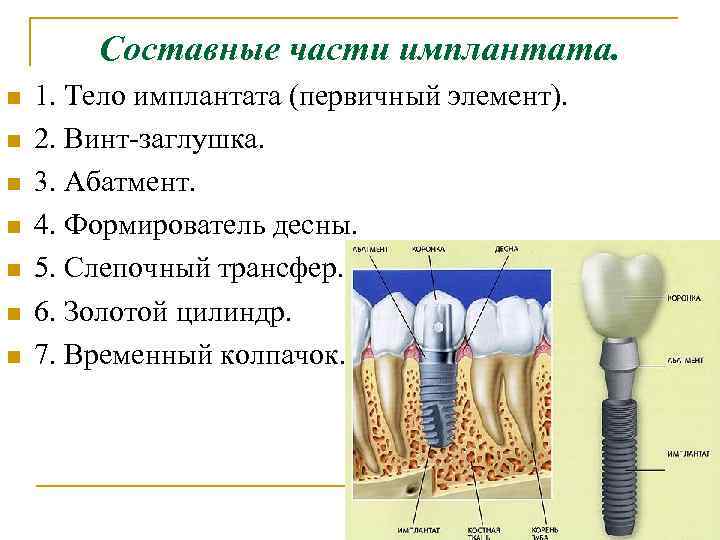 Составные части имплантата. n n n n 1. Тело имплантата (первичный элемент). 2. Винт-заглушка.