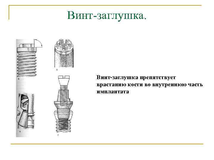 Винт-заглушка. Винт-заглушка препятствует врастанию кости во внутреннюю часть имплантата 