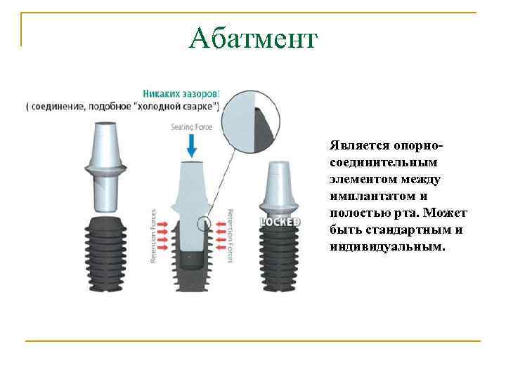 Абатмент Является опорносоединительным элементом между имплантатом и полостью рта. Может быть стандартным и индивидуальным.