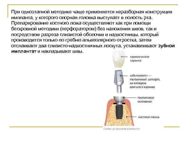 При одноэтапной методике чаще применяется неразборная конструкция импланта, у которого опорная головка выступает в