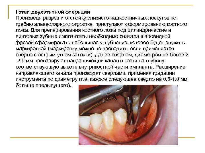 I этап двухэтапной операции Произведя разрез и отслойку слизисто-надкостничных лоскутов по гребню альвеолярного отростка,