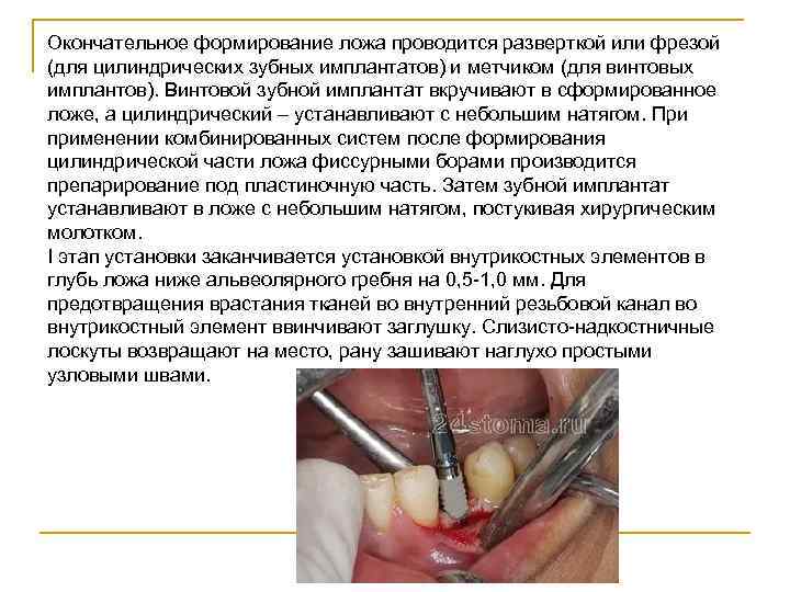 Окончательное формирование ложа проводится разверткой или фрезой (для цилиндрических зубных имплантатов) и метчиком (для