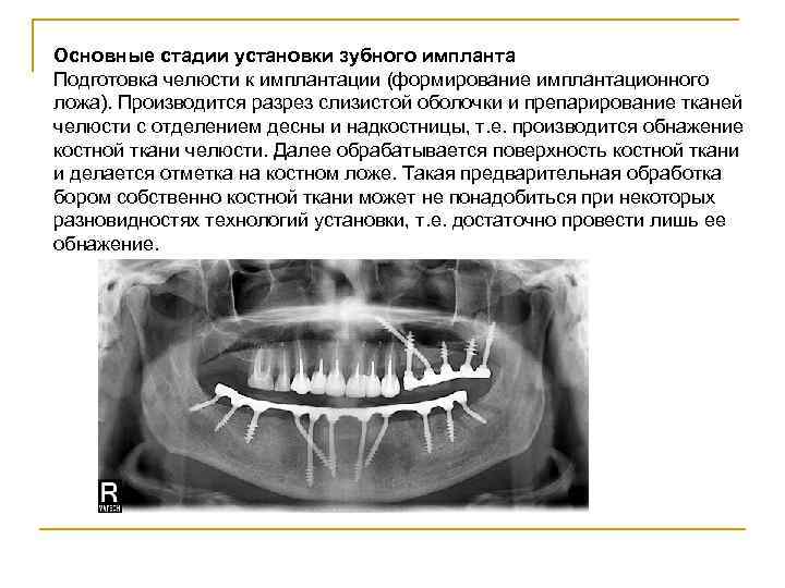 Основные стадии установки зубного импланта Подготовка челюсти к имплантации (формирование имплантационного ложа). Производится разрез