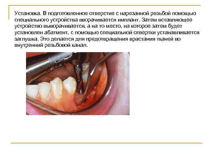 Установка. В подготовленное отверстие с нарезанной резьбой помощью специального устройства вворачивается имплант. Затем вставляющее