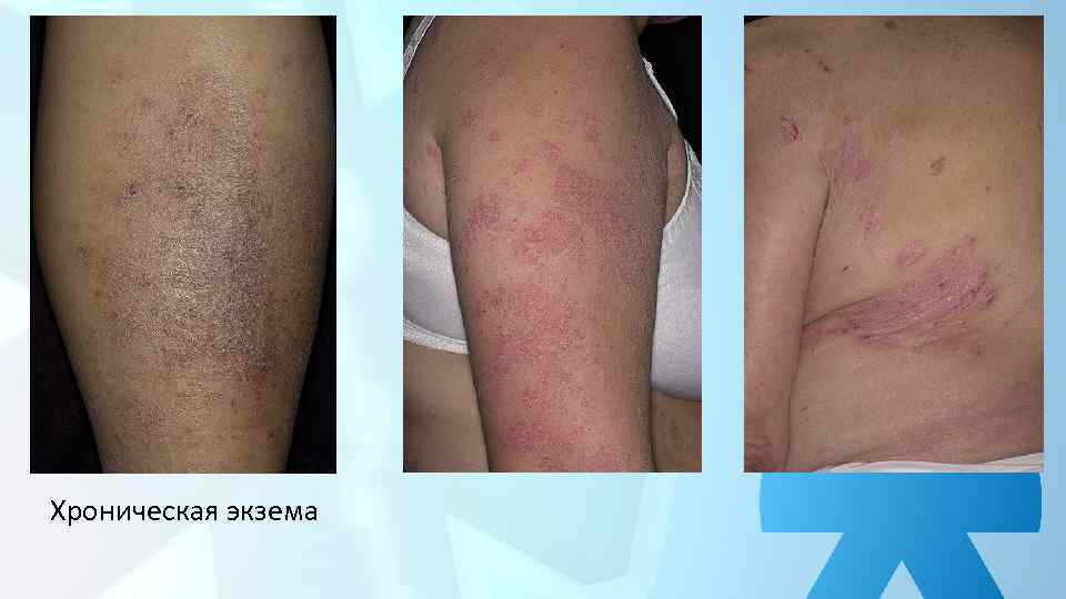 Хроническая экзема 