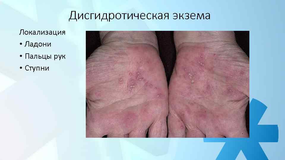 Дисгидротическая экзема Локализация • Ладони • Пальцы рук • Ступни 