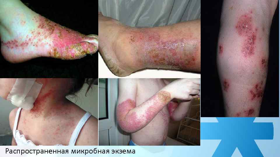 Распространенная микробная экзема 