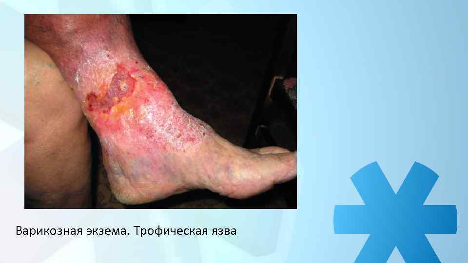 Варикозная экзема. Трофическая язва 