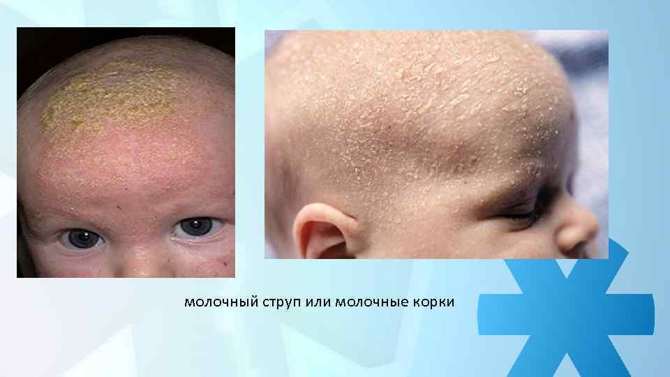 молочный струп или молочные корки 