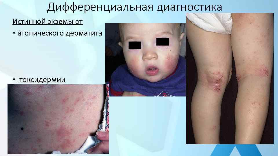 Дифференциальная диагностика Истинной экземы от • атопического дерматита • токсидермии 