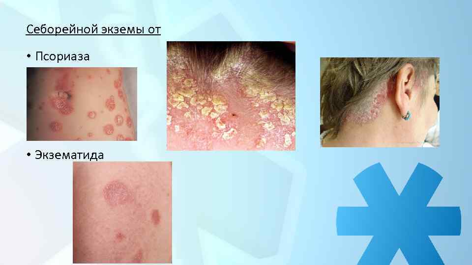 Себорейной экземы от • Псориаза • Экзематида 