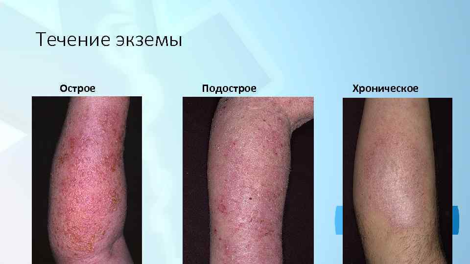Течение экземы Острое Подострое Хроническое 