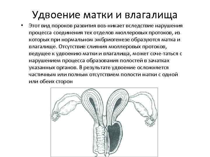 Удвоение матки и влагалища • Этот вид пороков развития воз никает вследствие нарушения процесса