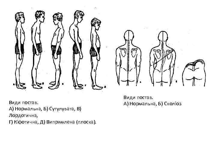 Види постав. А) Нормальна, Б) Сутулувата, В) Лордотична, Г) Кіфотична, Д) Випрямлена (плоска). Види