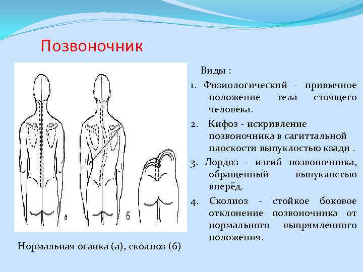 Позвоночник Нормальная осанка (а), сколиоз (б) Виды : 1. Физиологический - привычное положение тела