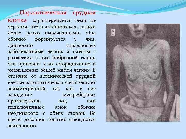  Паралитическая грудная клетка характеризуется теми же чертами, что и астеническая, только более резко