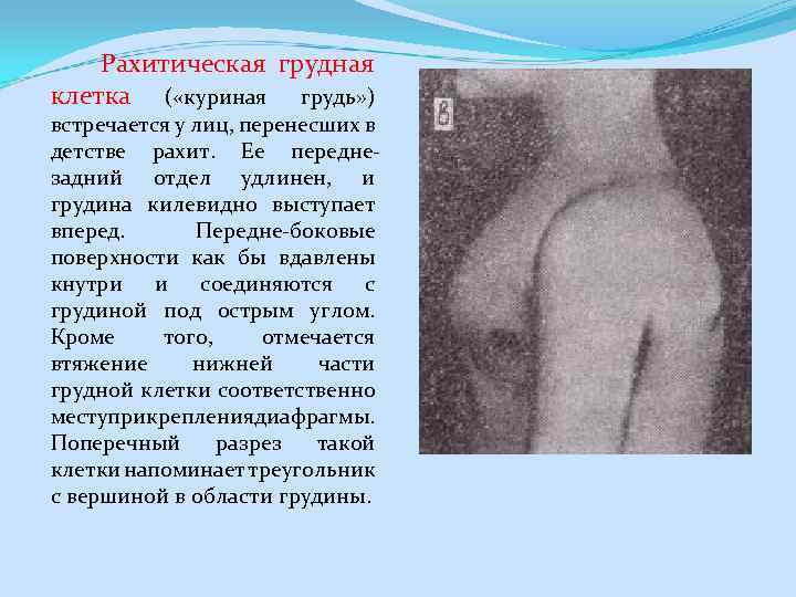  Рахитическая грудная клетка ( «куриная грудь» ) встречается у лиц, перенесших в детстве