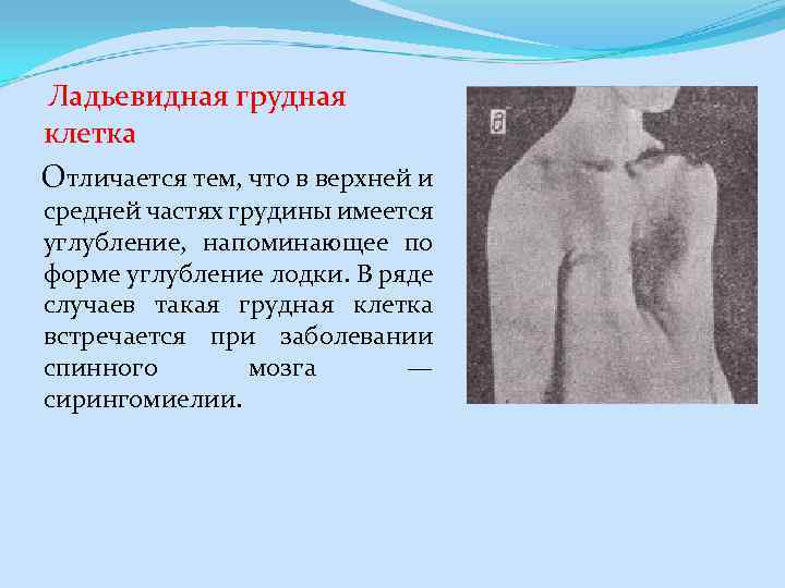  Ладьевидная грудная клетка Отличается тем, что в верхней и средней частях грудины имеется