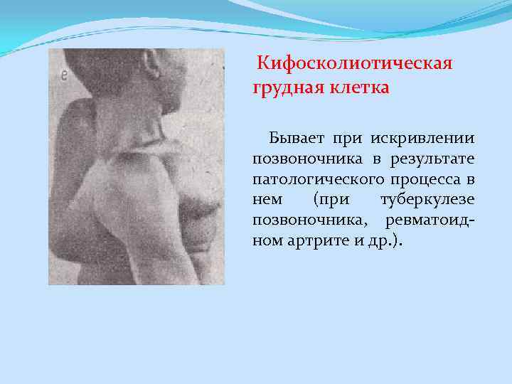  Кифосколиотическая грудная клетка Бывает при искривлении позвоночника в результате патологического процесса в нем