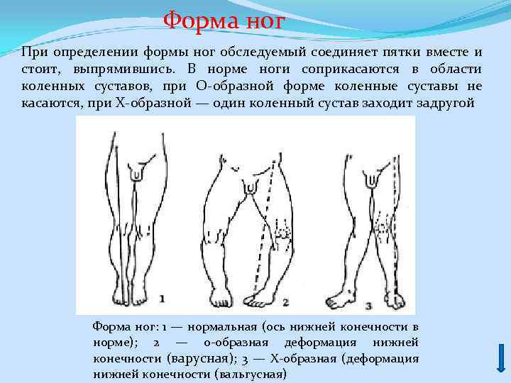  Форма ног При определении формы ног обследуемый соединяет пятки вместе и стоит, выпрямившись.