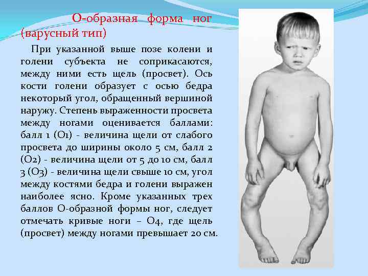 О-образная форма ног (варусный тип) При указанной выше позе колени и голени субъекта не