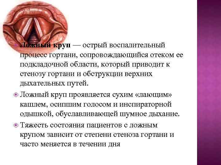  Ложный круп — острый воспалительный процесс гортани, сопровождающийся отеком ее подкладочной области, который