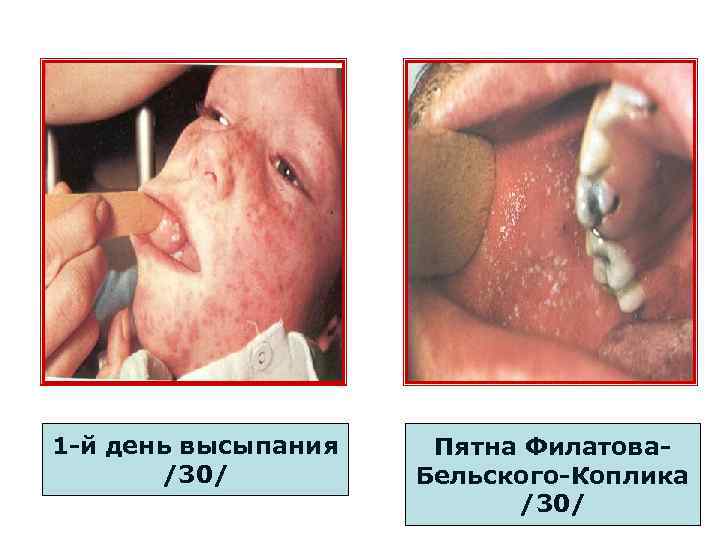 1 -й день высыпания /30/ Пятна Филатова. Бельского-Коплика /30/ 
