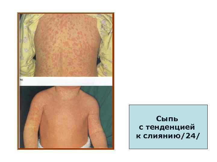 Сыпь с тенденцией к слиянию/24/ 