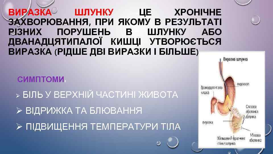 ВИРАЗКА ШЛУНКУ -ЦЕ ХРОНІЧНЕ ЗАХВОРЮВАННЯ, ПРИ ЯКОМУ В РЕЗУЛЬТАТІ РІЗНИХ ПОРУШЕНЬ В ШЛУНКУ АБО