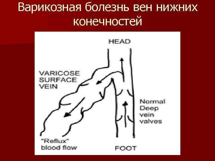 Варикозная болезнь вен нижних конечностей 