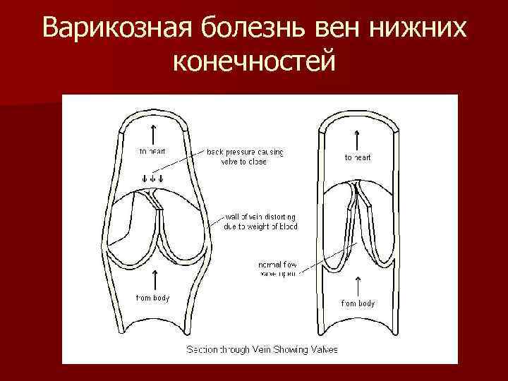 Варикозная болезнь вен нижних конечностей 