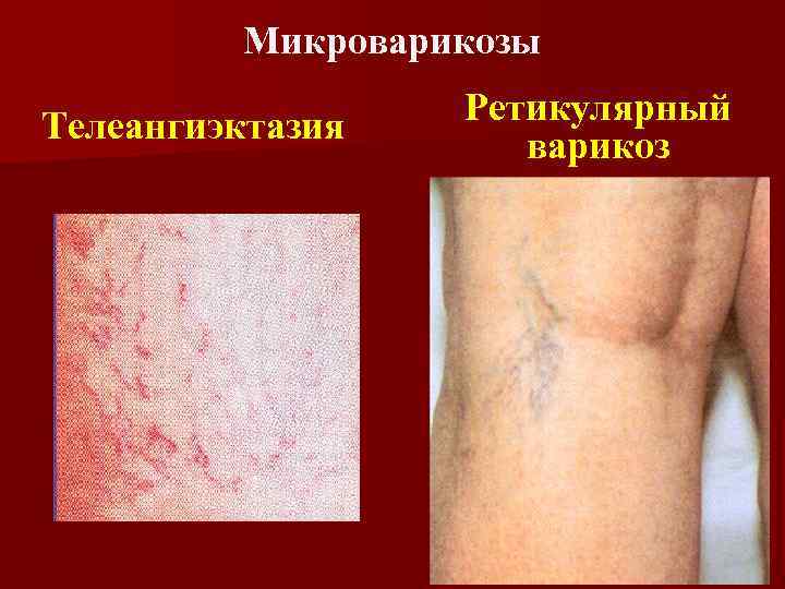 Микроварикозы Телеангиэктазия Ретикулярный варикоз 