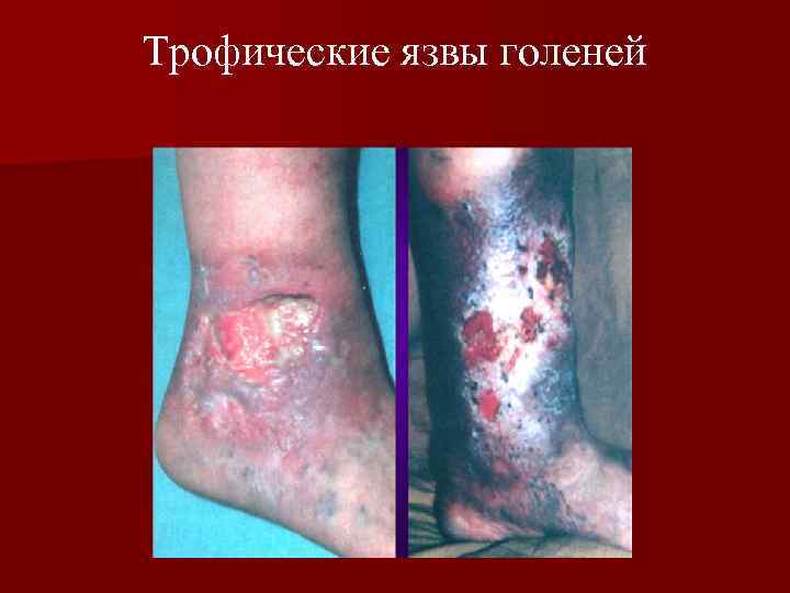 Трофические язвы голеней 