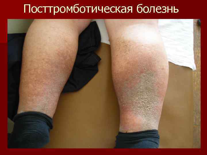 Посттромботическая болезнь 