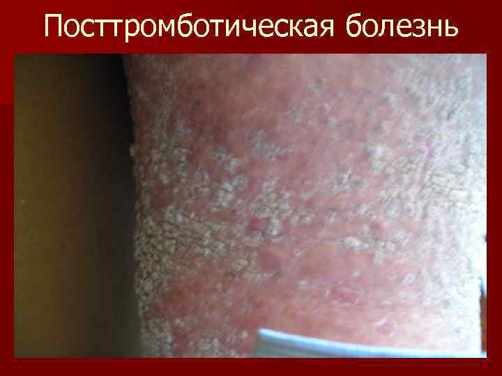 Посттромботическая болезнь 
