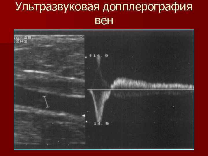 Ультразвуковая допплерография вен 