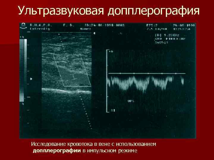 Ультразвуковая допплерография Исследование кровотока в вене с использованием допплерографии в импульсном режиме 