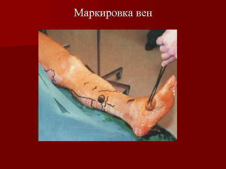 Маркировка вен 