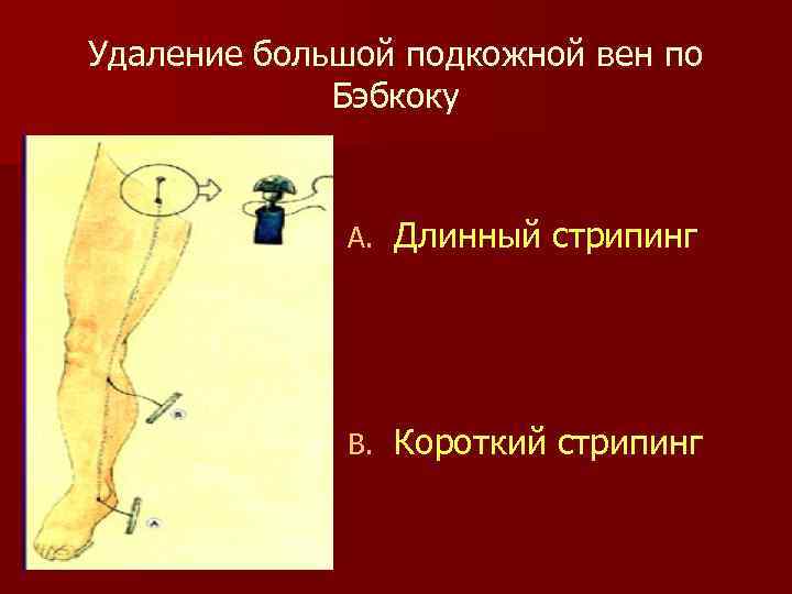 Удаление большой подкожной вен по Бэбкоку A. Длинный стрипинг B. Короткий стрипинг 