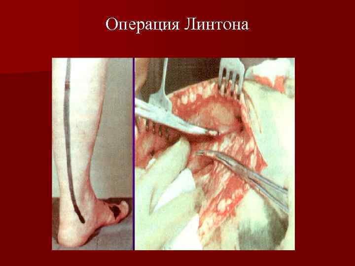 Операция Линтона 