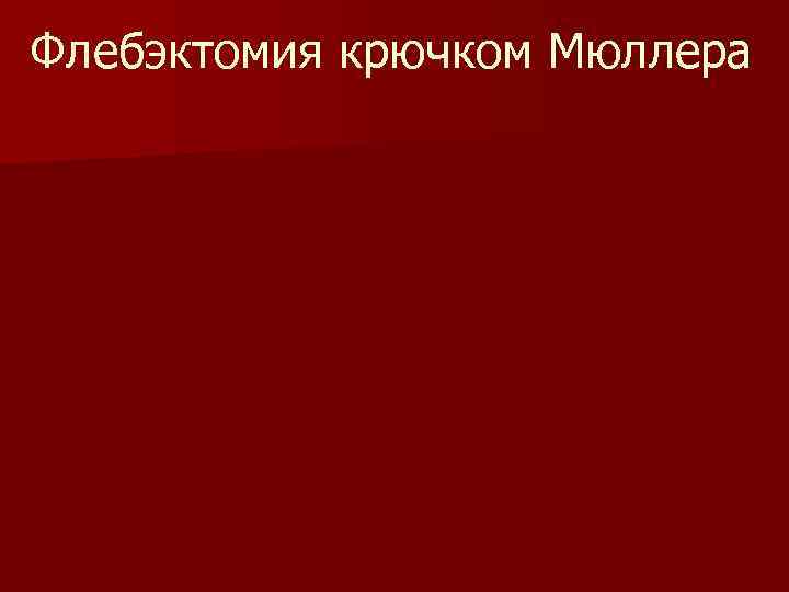 Флебэктомия крючком Мюллера 