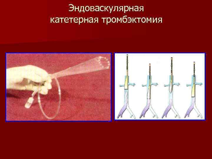 Эндоваскулярная катетерная тромбэктомия 