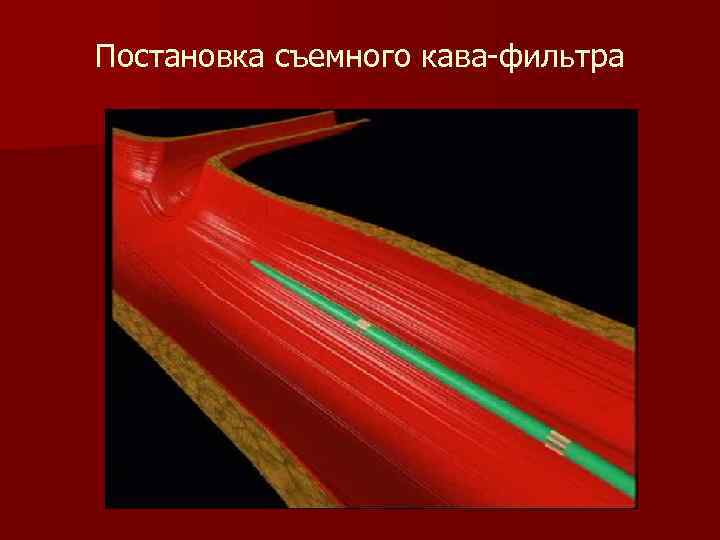 Постановка съемного кава-фильтра 